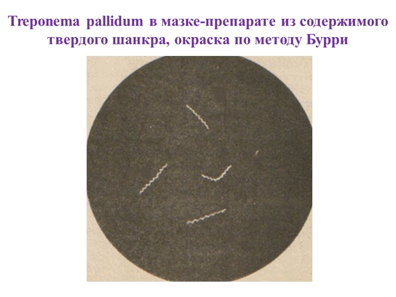 Treponema pallidum в мазке-препарате из содержимого твердого шанкра, окраска по методу Бурри
